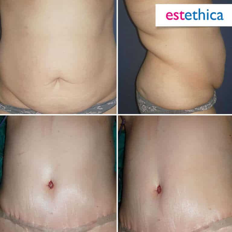 Abdominoplastie La Lipectomie Ou Plastie Abdominale Pour